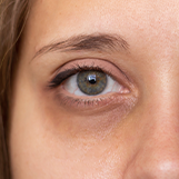 Tipos de tratamentos para olheiras