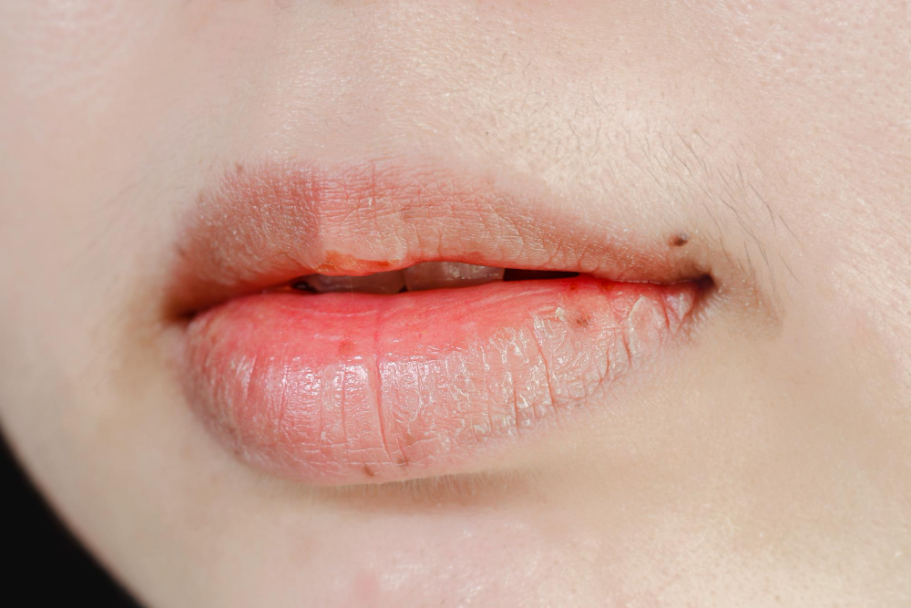 Lábios rachados: 4 dicas que ajudam a resolver o problema